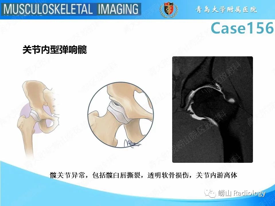 【PPT】臀中肌及臀小肌肌腱撕裂-25