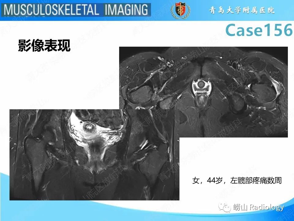 【PPT】臀中肌及臀小肌肌腱撕裂-20