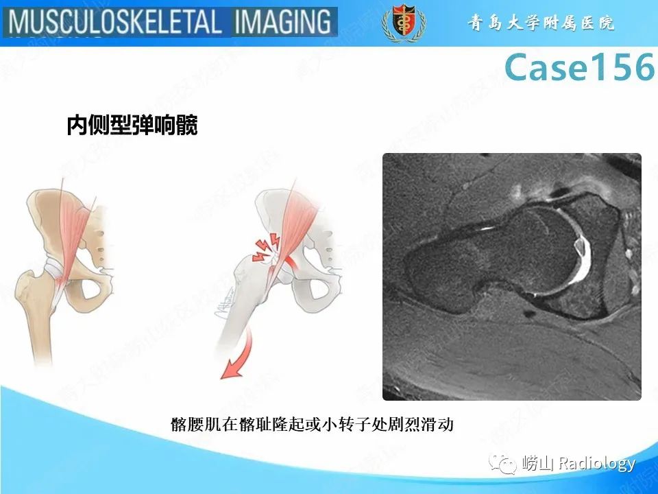 【PPT】臀中肌及臀小肌肌腱撕裂-24