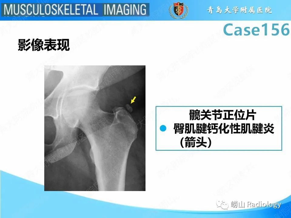 【PPT】臀中肌及臀小肌肌腱撕裂-27