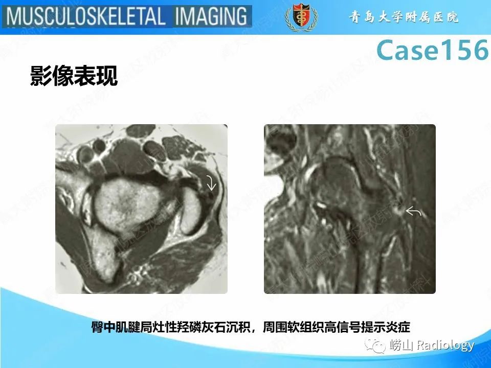 【PPT】臀中肌及臀小肌肌腱撕裂-28