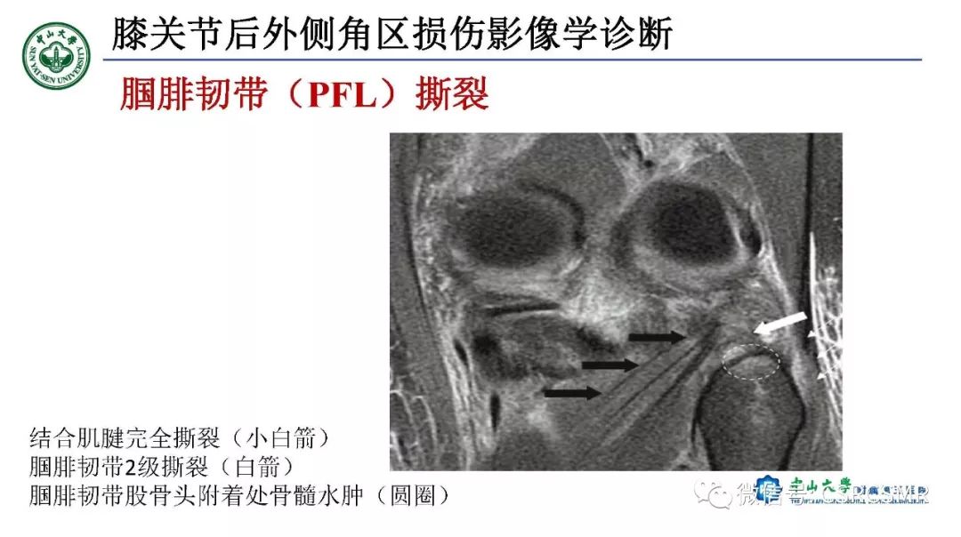 【PPT】膝关节后外侧角区影像解剖及损伤后影像学诊断-32