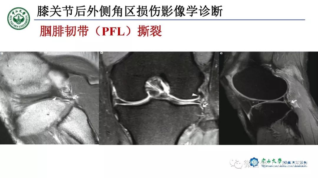 【PPT】膝关节后外侧角区影像解剖及损伤后影像学诊断-33