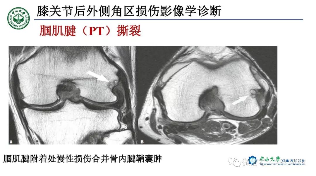 【PPT】膝关节后外侧角区影像解剖及损伤后影像学诊断-34