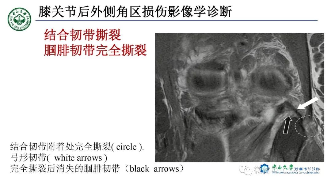 【PPT】膝关节后外侧角区影像解剖及损伤后影像学诊断-35