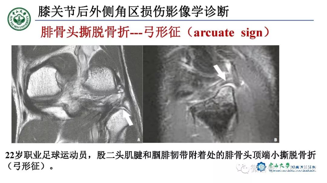 【PPT】膝关节后外侧角区影像解剖及损伤后影像学诊断-38
