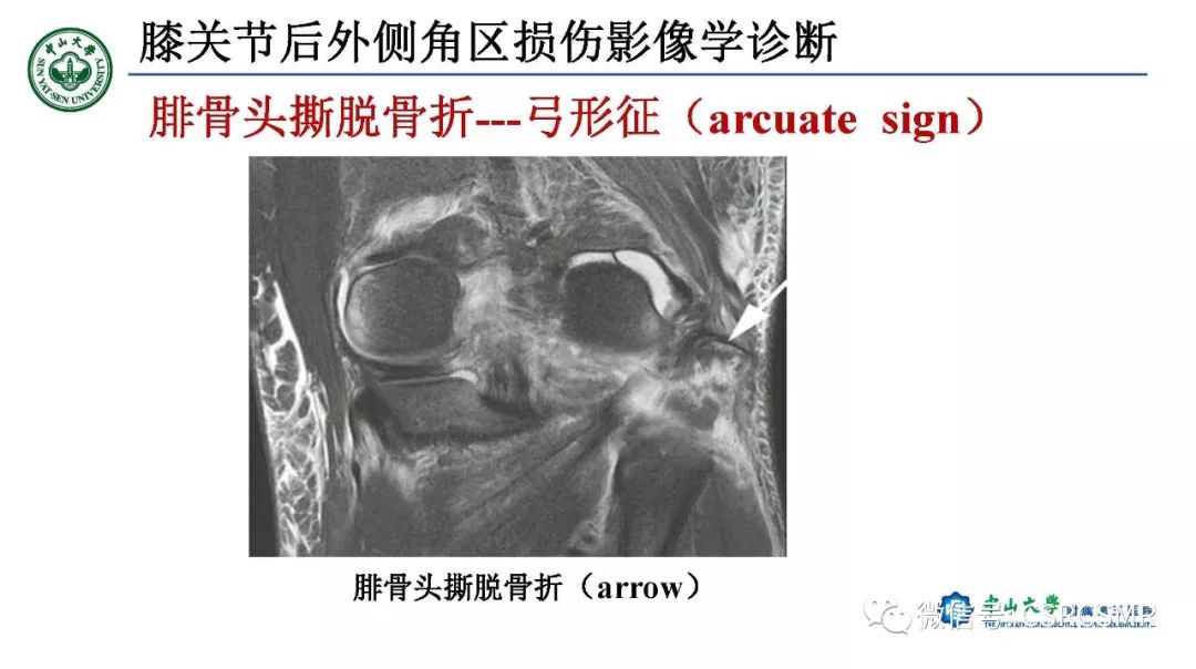 【PPT】膝关节后外侧角区影像解剖及损伤后影像学诊断-39