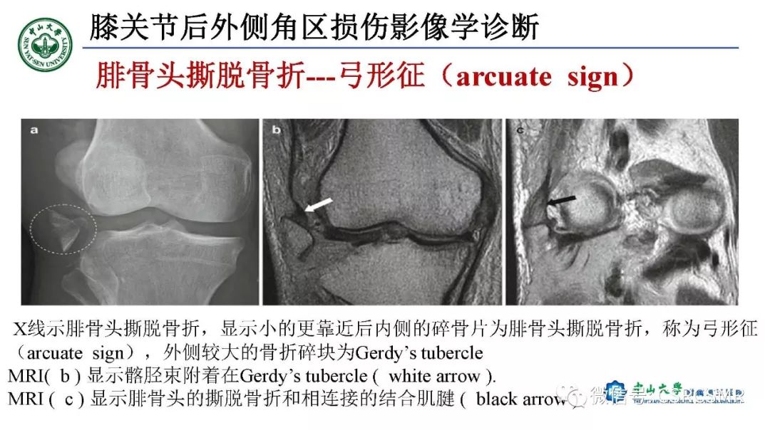 【PPT】膝关节后外侧角区影像解剖及损伤后影像学诊断-40