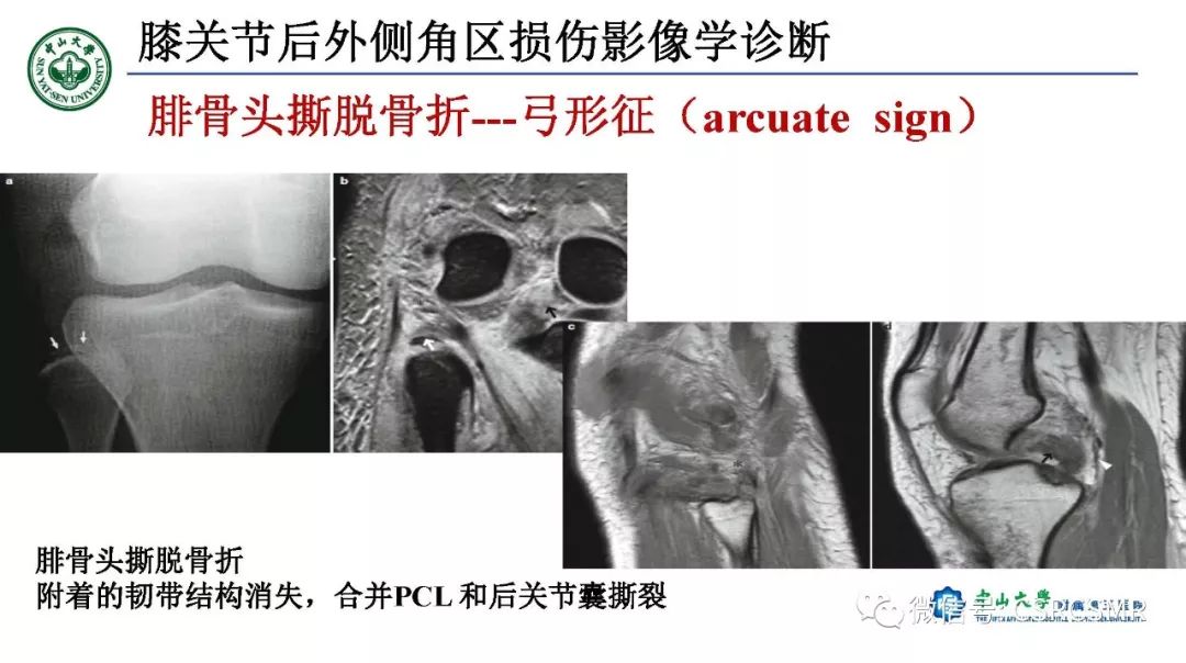 【PPT】膝关节后外侧角区影像解剖及损伤后影像学诊断-41