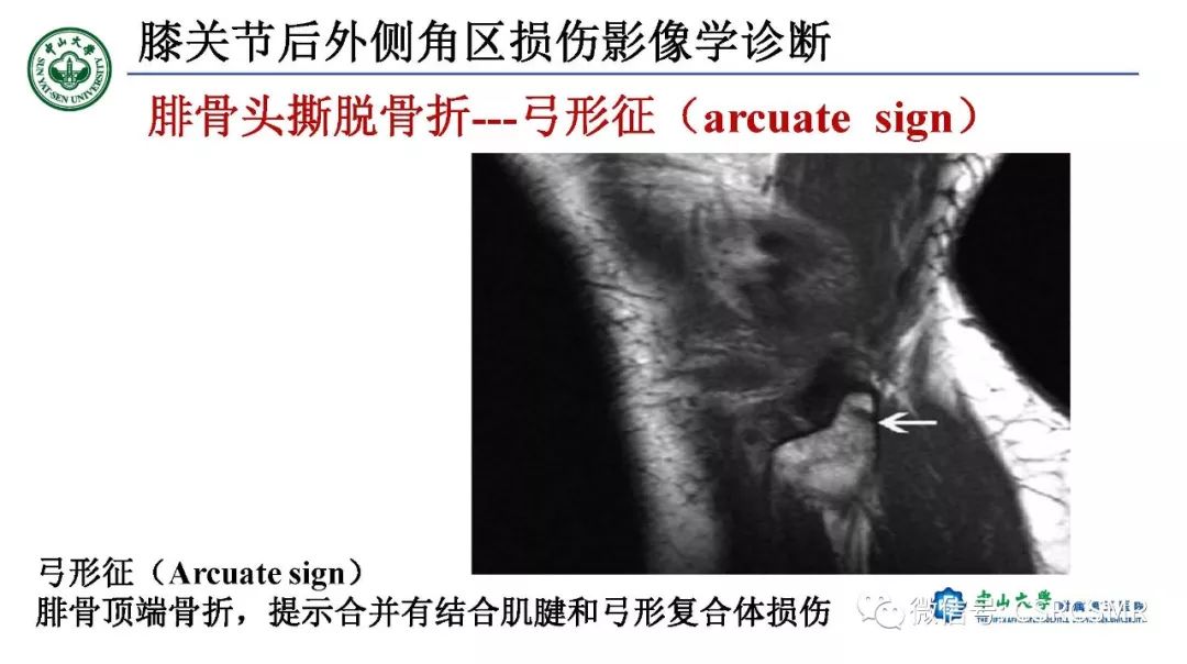 【PPT】膝关节后外侧角区影像解剖及损伤后影像学诊断-42