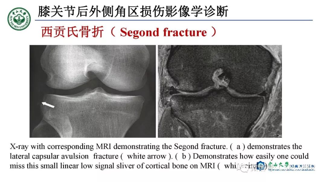 【PPT】膝关节后外侧角区影像解剖及损伤后影像学诊断-45