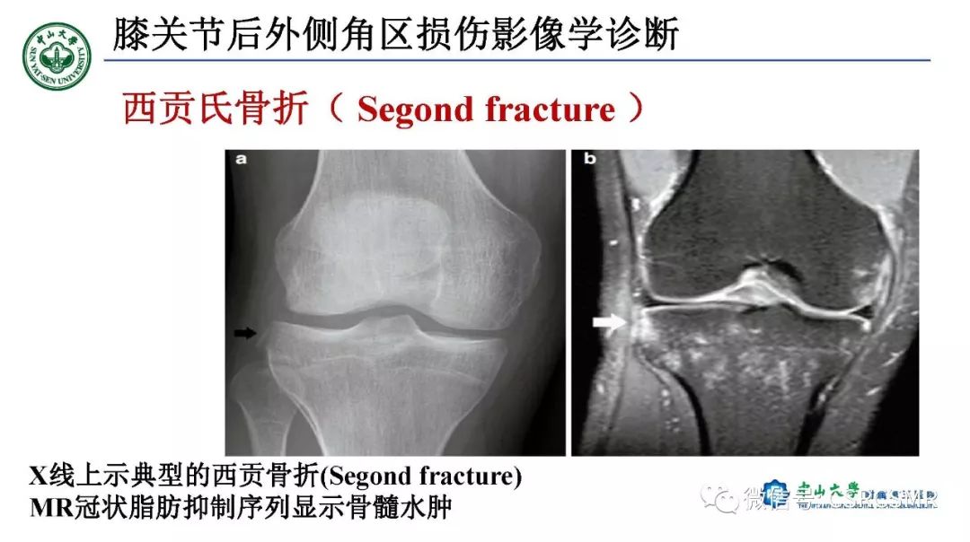 【PPT】膝关节后外侧角区影像解剖及损伤后影像学诊断-46