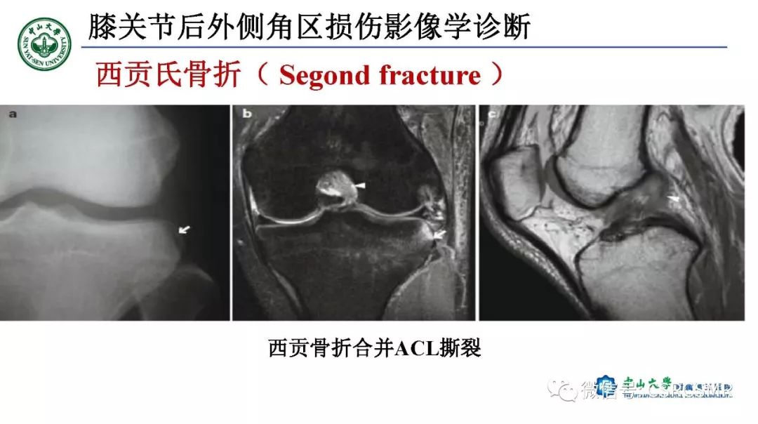 【PPT】膝关节后外侧角区影像解剖及损伤后影像学诊断-47