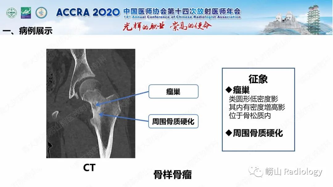 【PPT】关节内骨样骨瘤的影像诊断-10