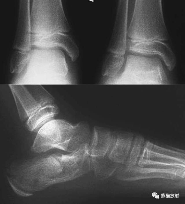 骨骺损伤的分型及影像表现-11