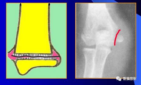 骨骺损伤的分型及影像表现-12