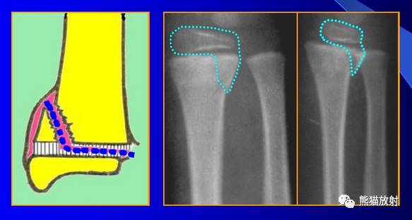 骨骺损伤的分型及影像表现-13