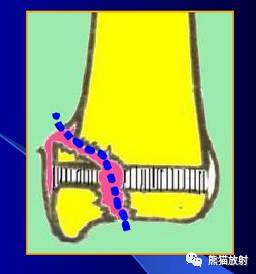 骨骺损伤的分型及影像表现-15