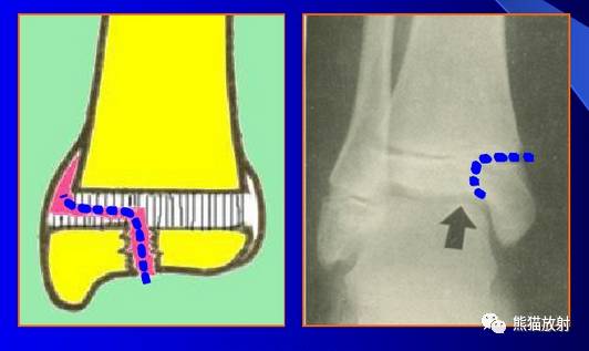 骨骺损伤的分型及影像表现-14