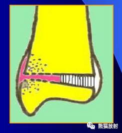 骨骺损伤的分型及影像表现-16