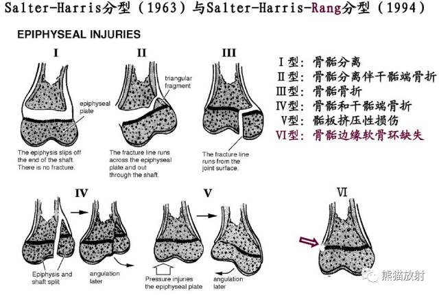 骨骺损伤的分型及影像表现-17