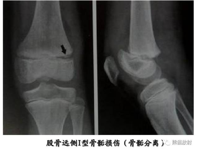 骨骺损伤的分型及影像表现-25
