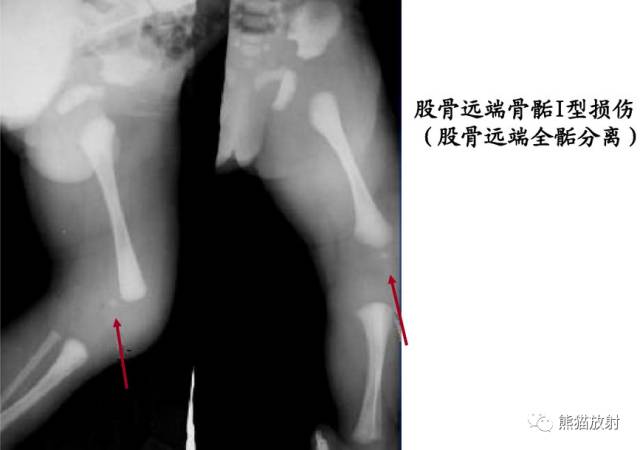 骨骺损伤的分型及影像表现-24