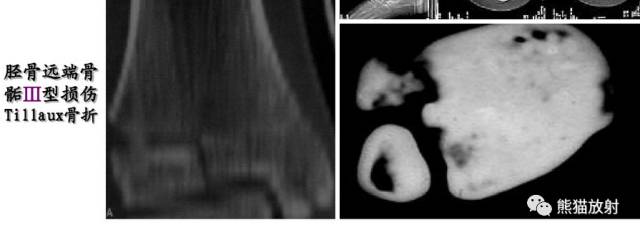 骨骺损伤的分型及影像表现-30