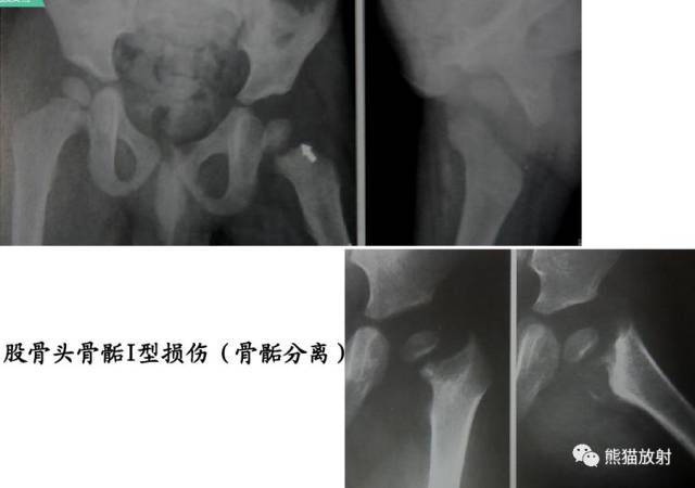 骨骺损伤的分型及影像表现-26