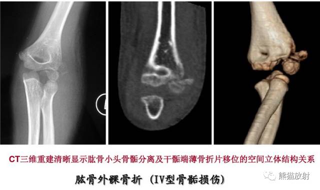 骨骺损伤的分型及影像表现-32