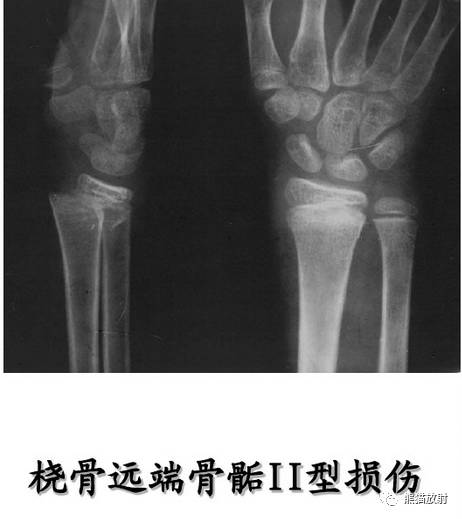 骨骺损伤的分型及影像表现-28