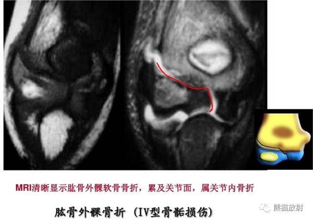 骨骺损伤的分型及影像表现-33