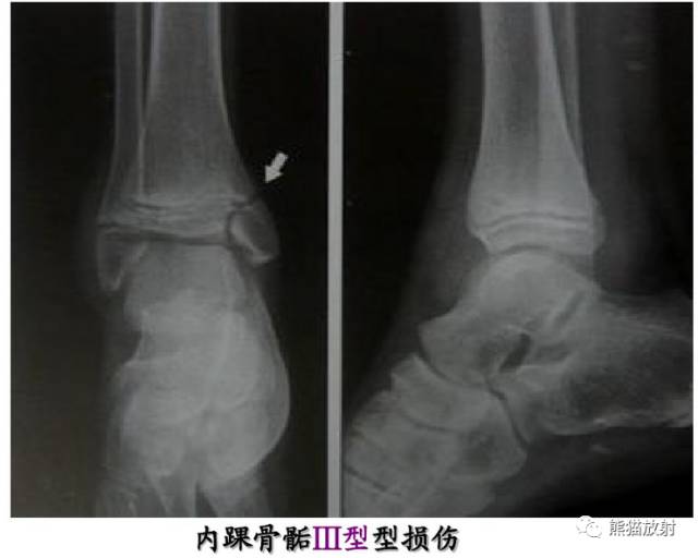 骨骺损伤的分型及影像表现-29