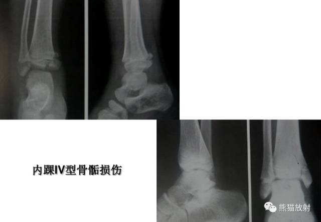 骨骺损伤的分型及影像表现-35