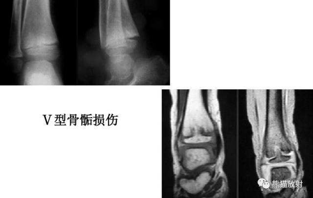 骨骺损伤的分型及影像表现-37