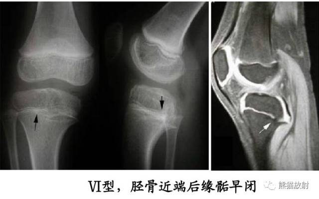 骨骺损伤的分型及影像表现-39