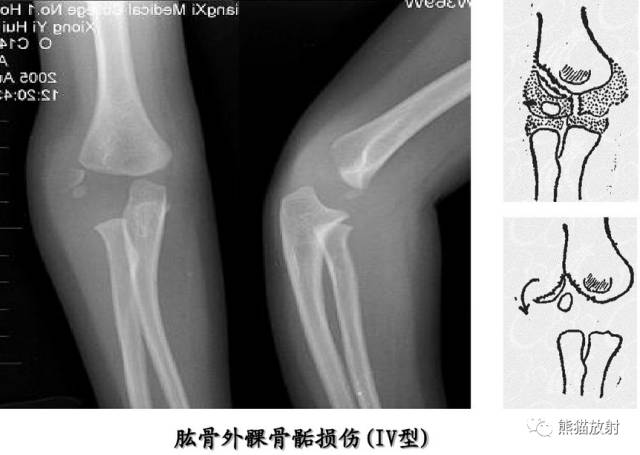 骨骺损伤的分型及影像表现-34