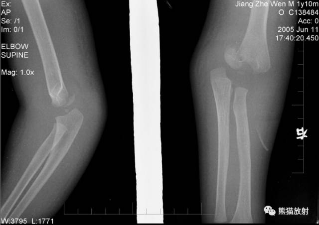 骨骺损伤的分型及影像表现-41