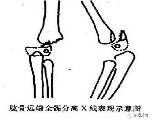 骨骺损伤的分型及影像表现-42