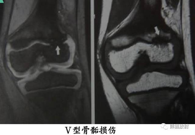 骨骺损伤的分型及影像表现-36