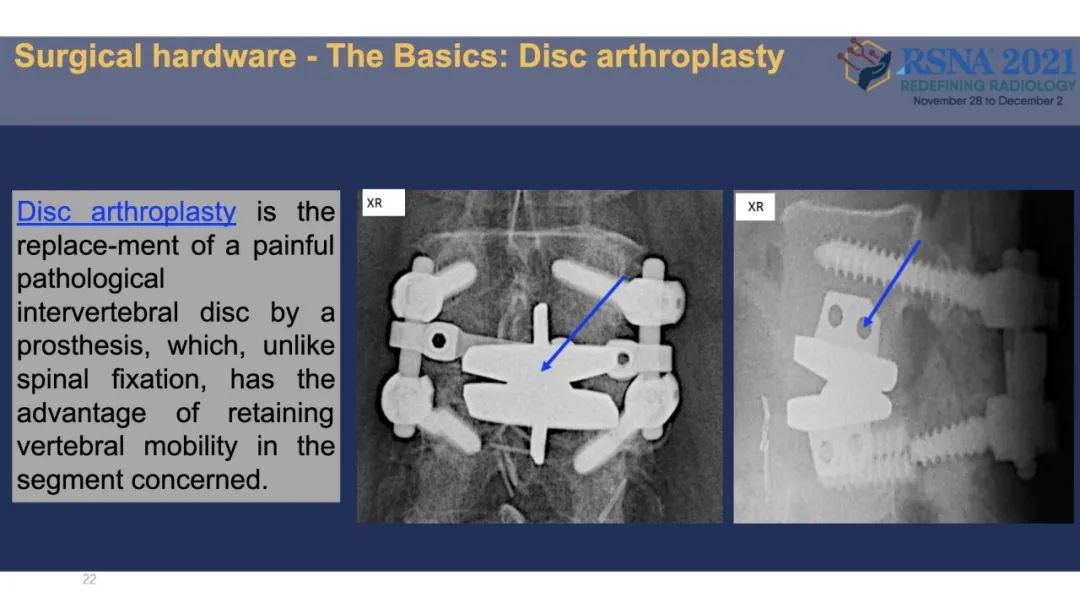 【PPT】术后脊柱-为了外科医生和患者安全着想的金属图像-22