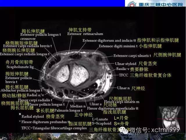 【PPT】腕关节MRI解剖中英对照-38