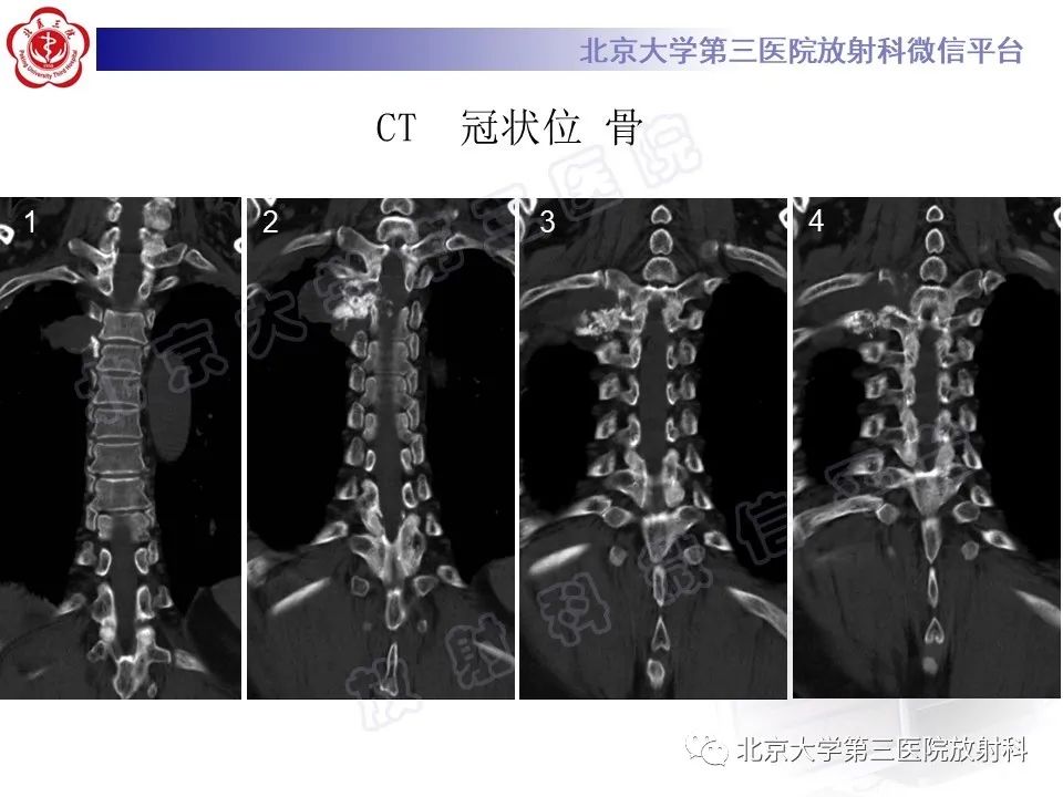 【PPT】脊柱软骨肉瘤-4
