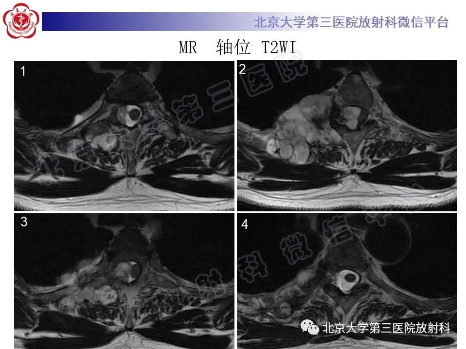 【PPT】脊柱软骨肉瘤-6