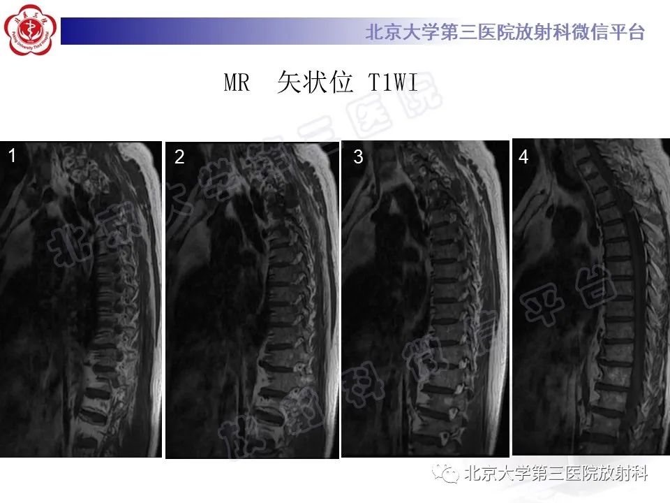 【PPT】脊柱软骨肉瘤-8