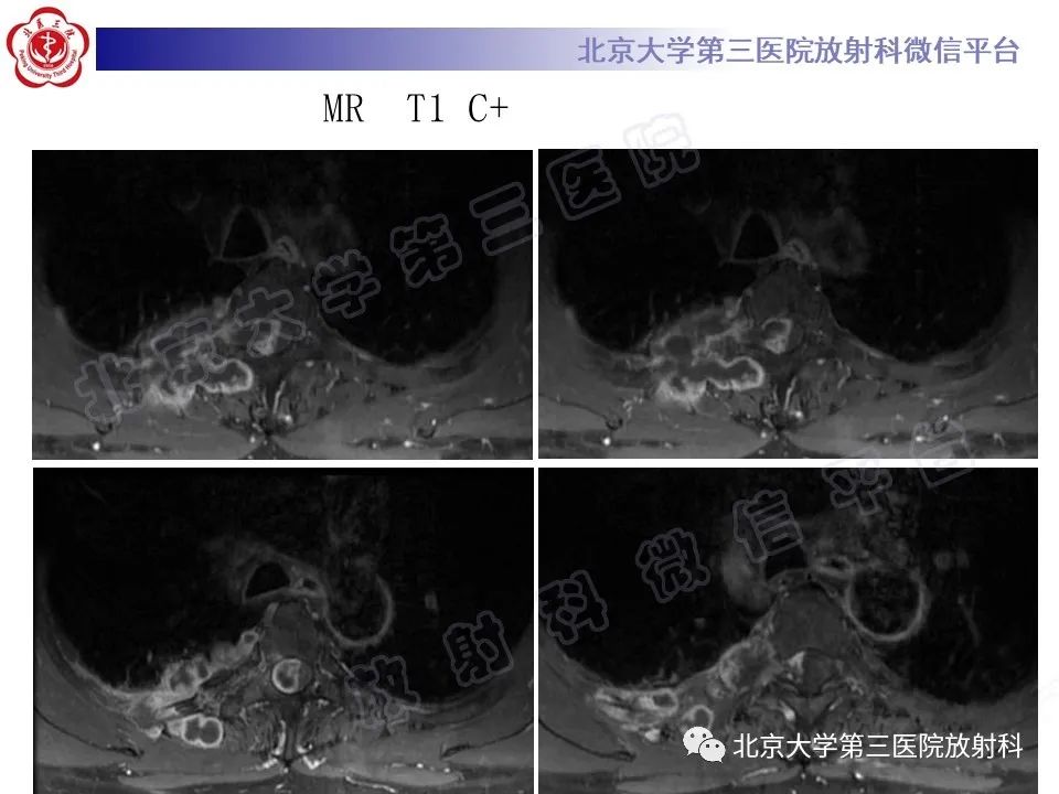 【PPT】脊柱软骨肉瘤-10
