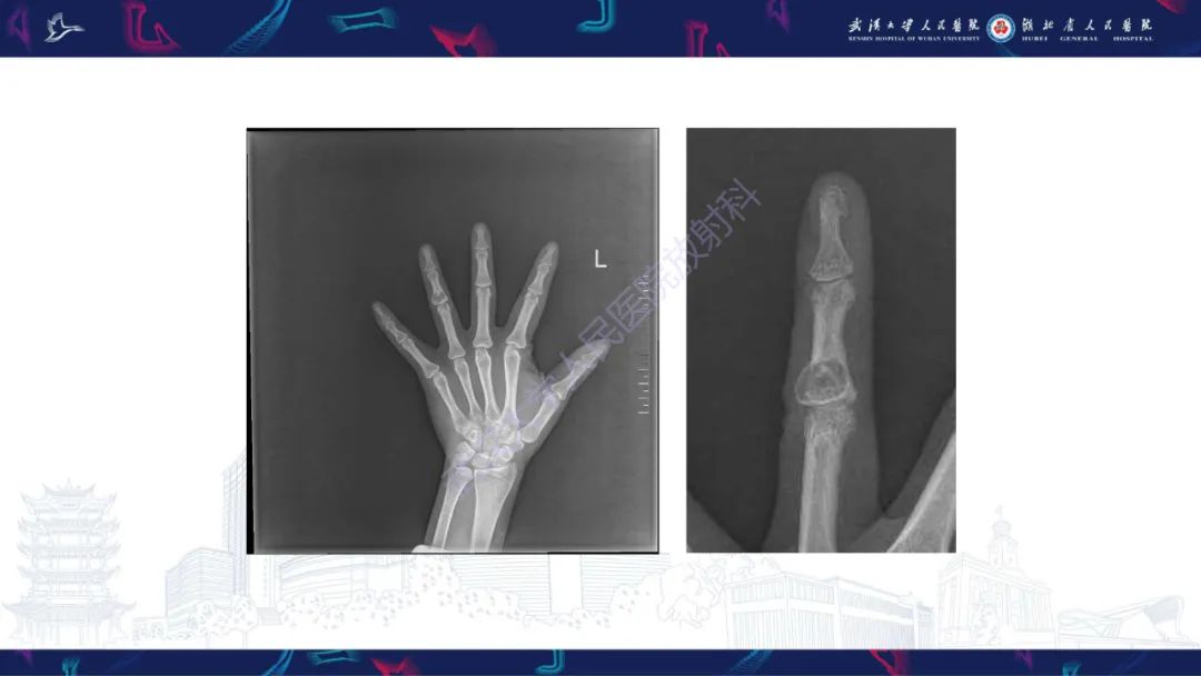 【PPT】指骨肿瘤影像诊断-6