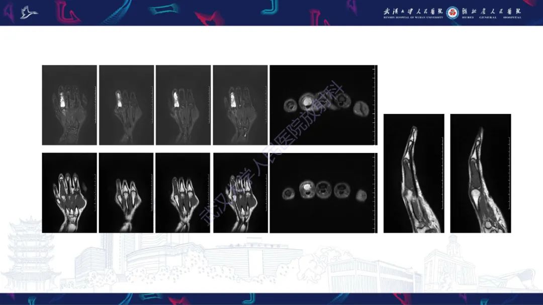 【PPT】指骨肿瘤影像诊断-4