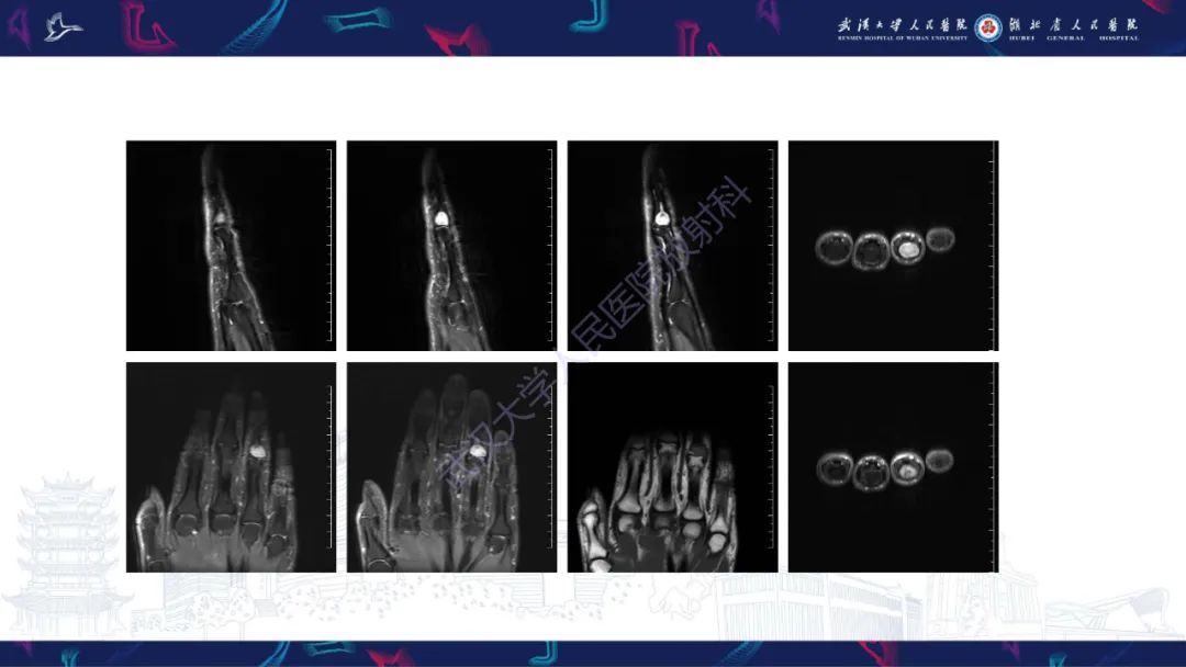 【PPT】指骨肿瘤影像诊断-8