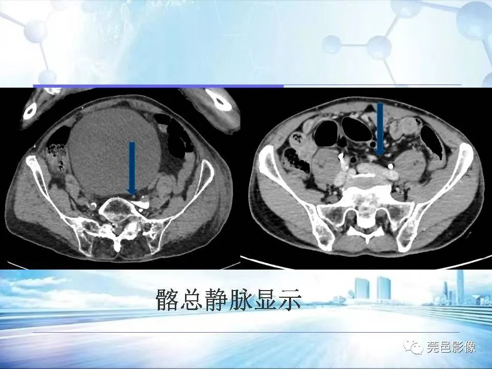 【PPT】浅谈下肢静脉CTV的应用体会-17